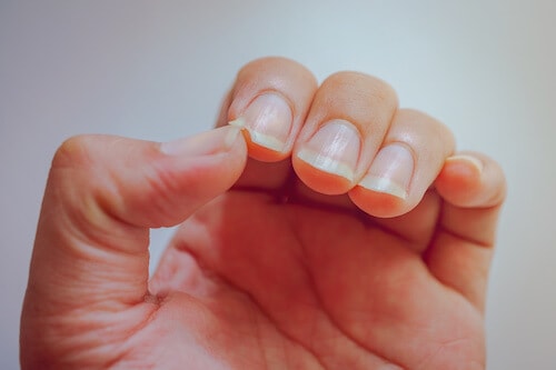 reasons for brittle nails